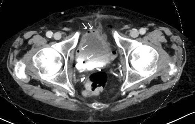 pneumaturia